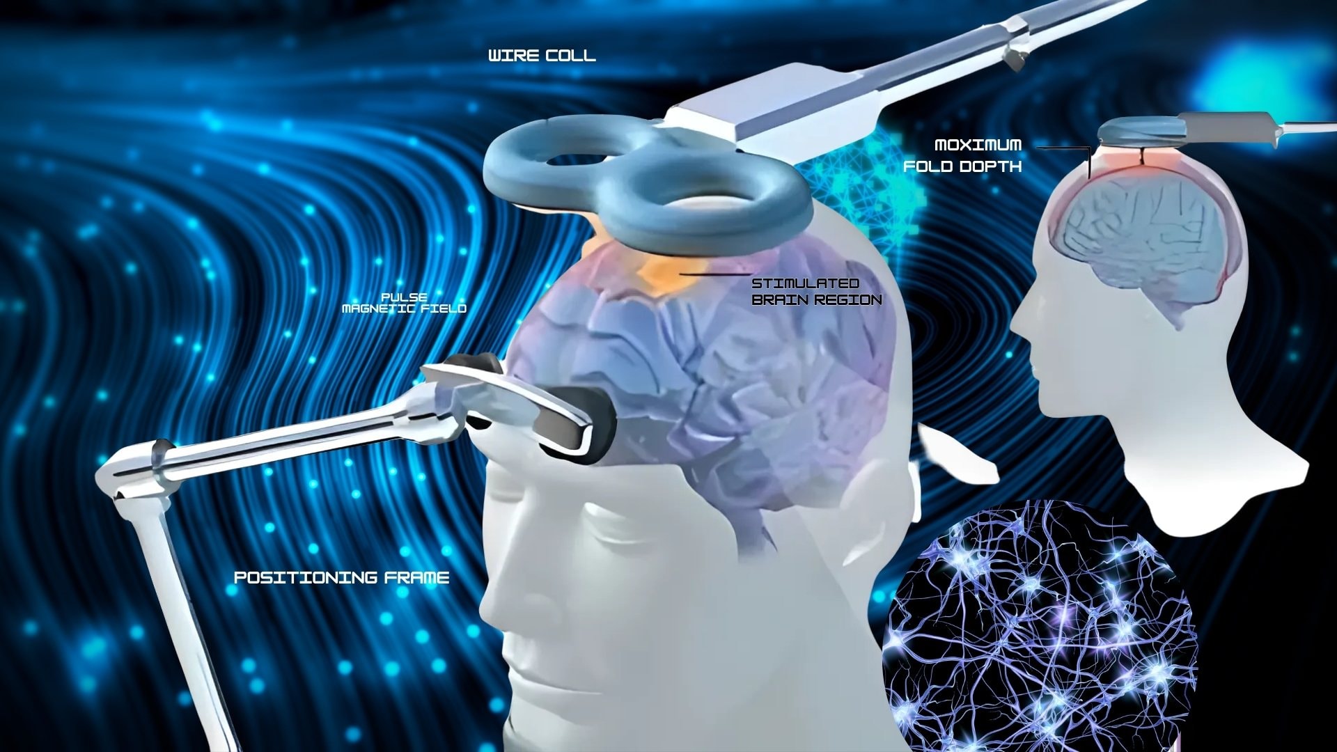 Understanding How TMS Therapy Works for Mental Health Treatment